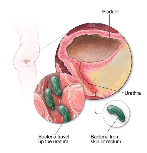 Diagram of bacteria travelling through the female urinary tract